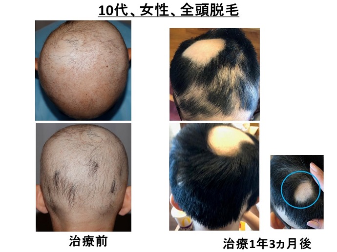円形脱毛症　病院